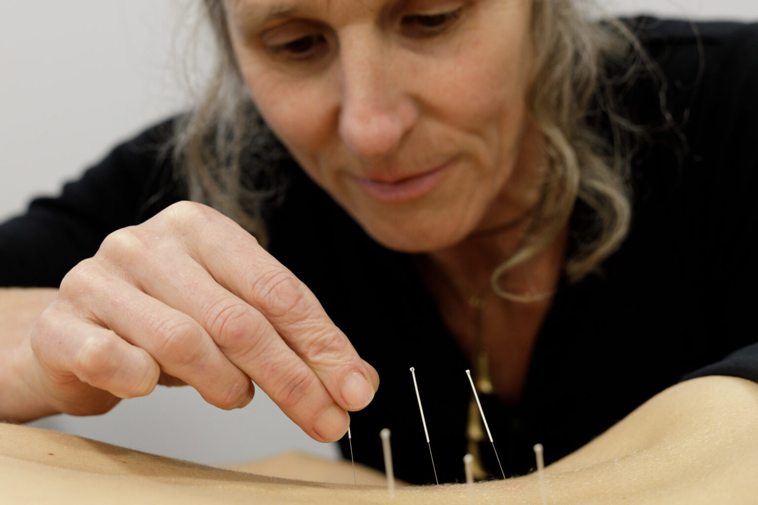 Acupuncture Vivian Street Osteopaths